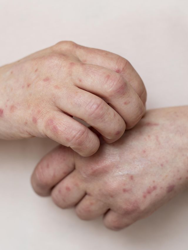 Sarampo: saiba quais são os sintomas, transmissão, tratamento e prevenção